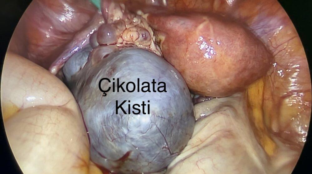 1) Çikolata kisti, endometriozisle ⁤ilişkilendirilen bir ⁤kist türüdür