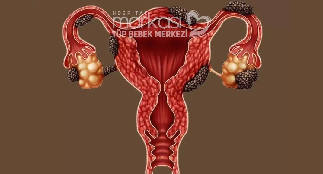 1)‍ Çikolata kisti, endometriozis sonucu oluşan kist türüdür