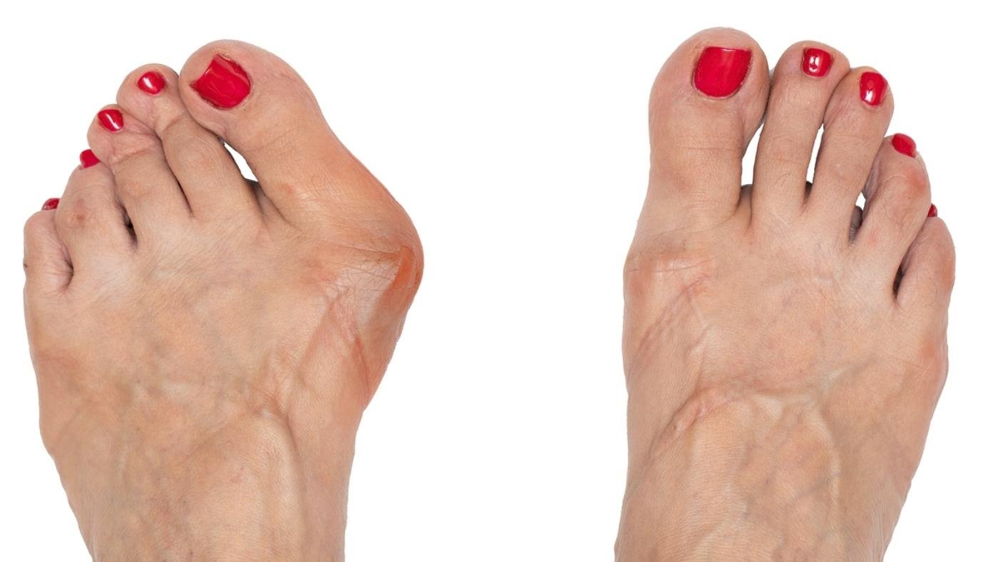 5) Hallux ⁤valgus tedavi seçenekleri: cerrahi ve‍ cerrahi olmayan yöntemler