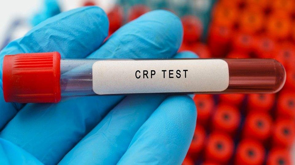 CRP Nedir? C-Reaktif Protein Hakkında 10 Bilgi