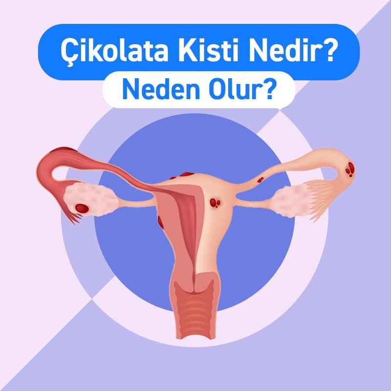 Çikolata Kisti Nedir? 10 Bilgiyle Tanıyın ve Anlayın