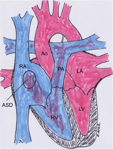 Atriyal Septal Defekt Nedir? 10 Önemli Nokta