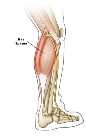 Spazm Nedir? İçinde Barındırdığı 10 Temel Gerçek