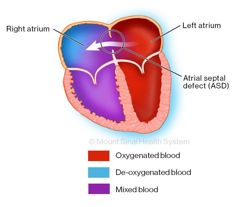 1) Atriyal septal defektin tanımı ve önemi