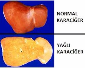 7)⁤ Yağlı karaciğer hastalığı, GGT yükselmesine yol açabilir