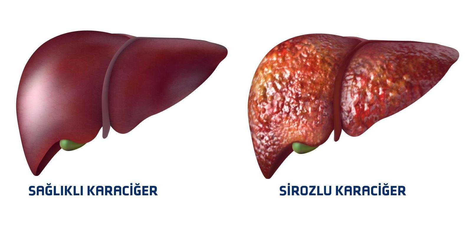 5) Karaciğer sirozunda ödem tedavisinde etkili mi?