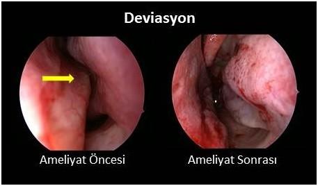 4)​ Burun tıkanıklığını açarak solunum yollarını rahatlatır