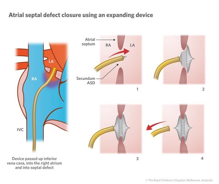 6) Atriyal septal defekti nasıl tedavi ⁣edilir?