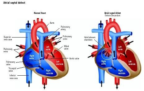 9) Atriyal septal defektin uzun vadeli etkileri