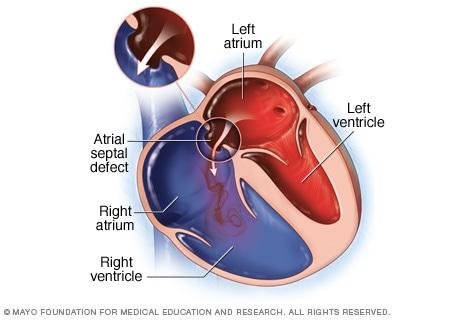 4) Atriyal septal defektin nedenleri ve risk faktörleri