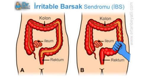 9)⁣ İrritabl bağırsak sendromu tanısı