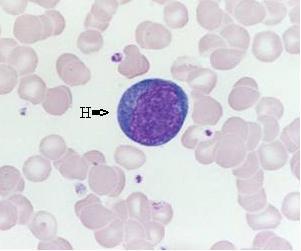 7) Kan tahlilinde atypical lymphocytes bulguları