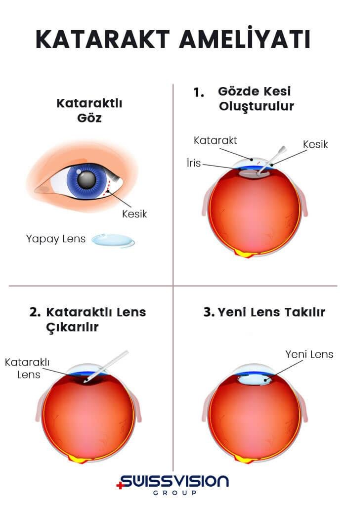 5) Katarakt ‌Türleri: Doğumsal,‍ yaşa bağlı ve travmaya bağlı katarakt çeşitleri