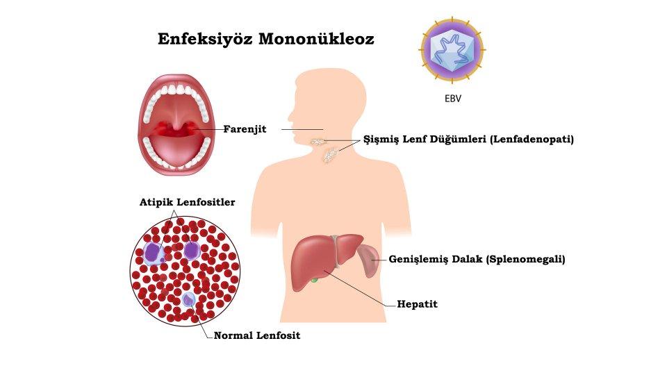 6) Epstein-Barr⁤ virüsü ve mononükleoz‍ ilişkisi