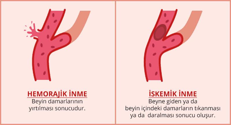 1) Inme nedir ve nasıl oluşur?