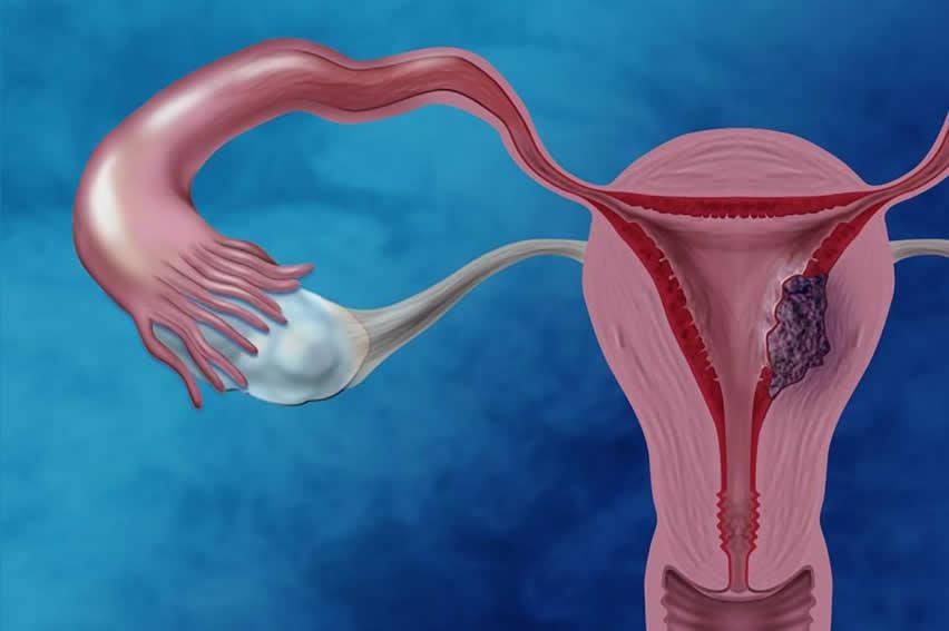 1) Rahim duvarı kalınlaşması, endometrial hiperpalsi olarak ⁤da bilinir