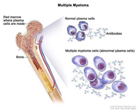 7) ⁢Multiple myeloma, plazma hücrelerinin kanseridir ve kemik iliğinde ​ağrıya neden olabilir