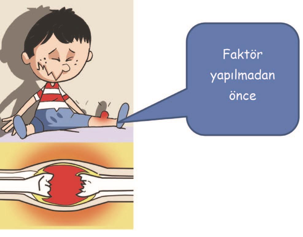 4) Hemofili,kanın pıhtılaşma yeteneğinin ​eksik olduğuna dair genetik bir hastalıktır