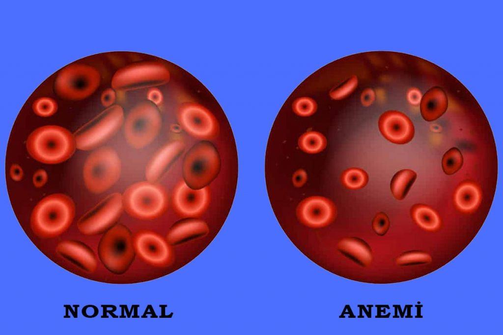 2)​ Anemi, kansızlık anlamına gelir ve vücudun yeterli‌ hemoglobin üretmemesinden kaynaklanır